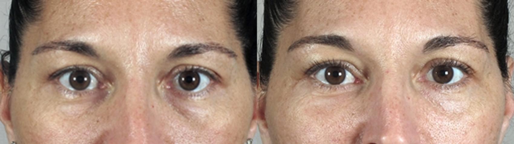 Eyelid Lift Case 282 Before & After View #1 | Paramus, New Jersey | Parker Center for Plastic Surgery