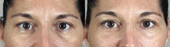 Eyelid Lift Case 282 Before & After View #1 | Paramus, New Jersey | Parker Center for Plastic Surgery