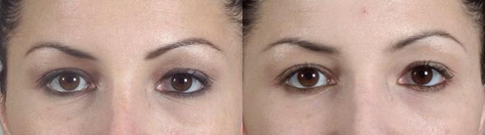 Eyelid Lift Case 285 Before & After View #1 | Paramus, New Jersey | Parker Center for Plastic Surgery