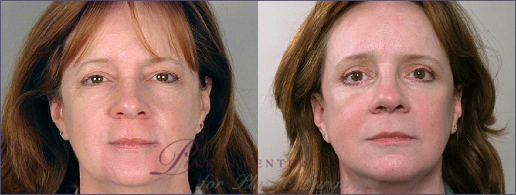 Eyelid Lift Case 4 Before & After View #1 | Paramus, NJ | Parker Center for Plastic Surgery