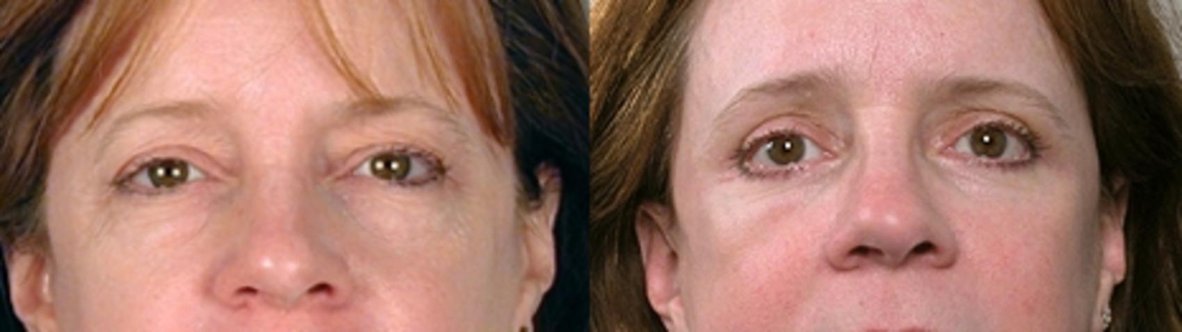 Eyelid Lift Case 4 Before & After View #1 | Paramus, New Jersey | Parker Center for Plastic Surgery