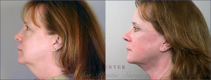 Eyelid Lift Case 4 Before & After View #2 | Paramus, NJ | Parker Center for Plastic Surgery