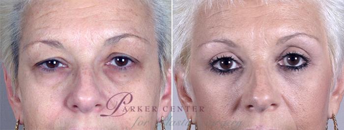 Eyelid Lift Case 47 Before & After View #1 | Paramus, NJ | Parker Center for Plastic Surgery