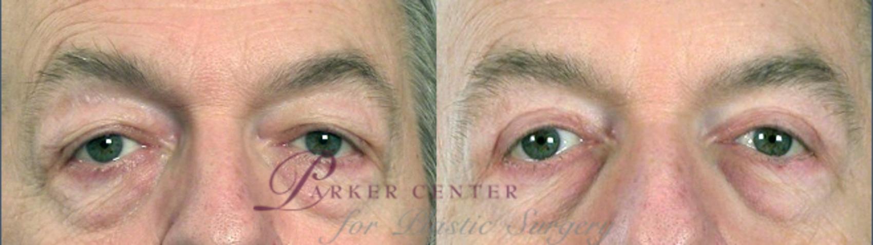 Eyelid Lift Case 49 Before & After View #1 | Paramus, NJ | Parker Center for Plastic Surgery