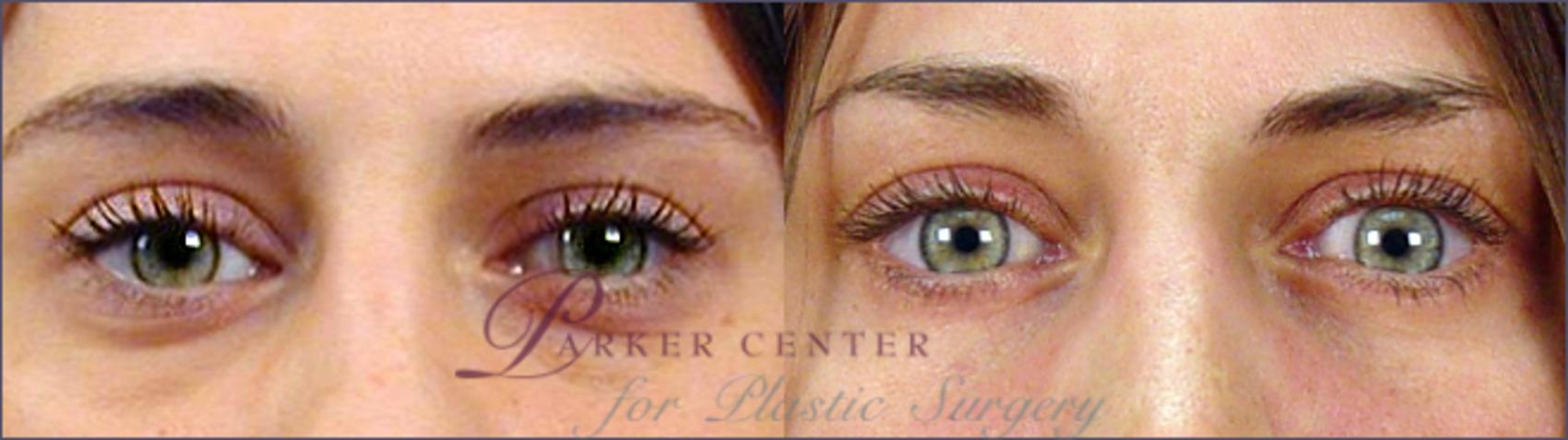Eyelid Lift Case 54 Before & After View #1 | Paramus, NJ | Parker Center for Plastic Surgery
