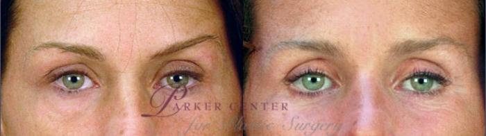 Eyelid Lift Case 55 Before & After View #1 | Paramus, NJ | Parker Center for Plastic Surgery