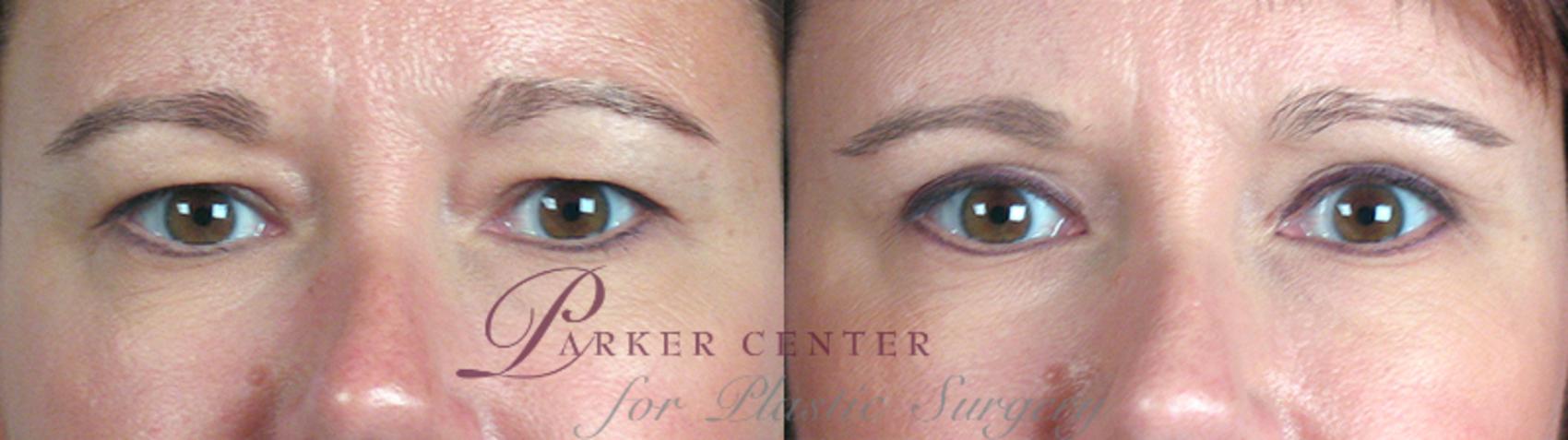 Eyelid Lift Case 58 Before & After View #1 | Paramus, NJ | Parker Center for Plastic Surgery