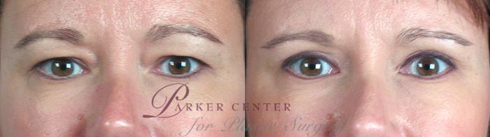 Eyelid Lift Case 58 Before & After View #1 | Paramus, NJ | Parker Center for Plastic Surgery