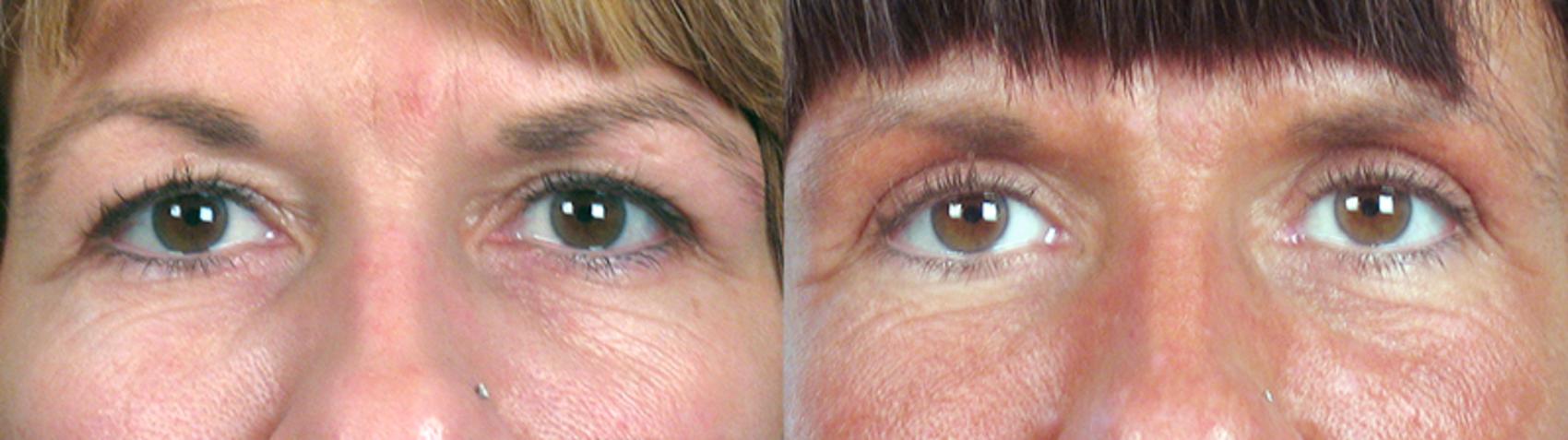 Eyelid Lift Case 59 Before & After View #1 | Paramus, New Jersey | Parker Center for Plastic Surgery