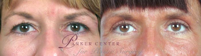 Eyelid Lift Case 59 Before & After View #1 | Paramus, NJ | Parker Center for Plastic Surgery