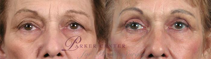 Eyelid Lift Case 60 Before & After View #1 | Paramus, NJ | Parker Center for Plastic Surgery