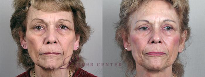 Eyelid Lift Case 60 Before & After View #2 | Paramus, NJ | Parker Center for Plastic Surgery