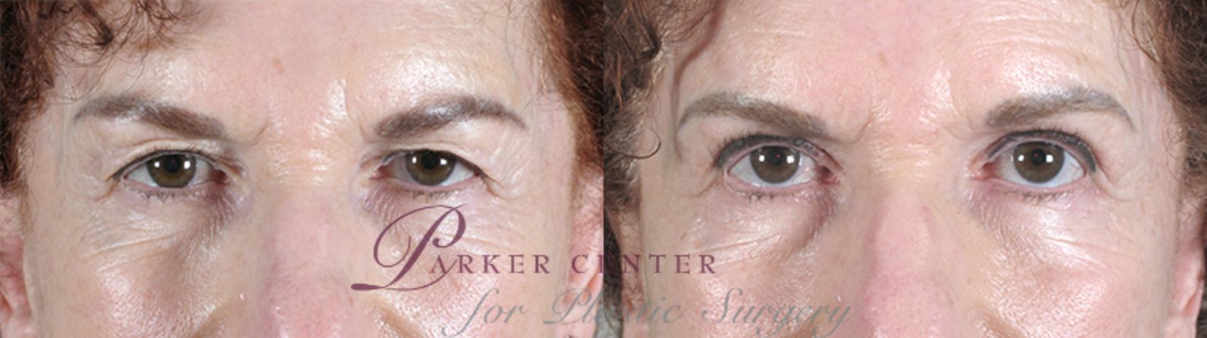 Eyelid Lift Case 61 Before & After View #1 | Paramus, NJ | Parker Center for Plastic Surgery