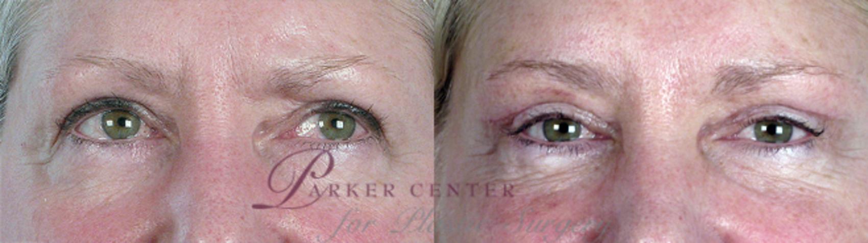 Eyelid Lift Case 62 Before & After View #1 | Paramus, NJ | Parker Center for Plastic Surgery