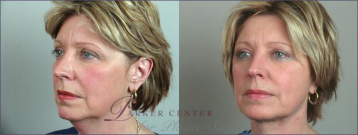 Eyelid Lift Case 63 Before & After View #1 | Paramus, NJ | Parker Center for Plastic Surgery
