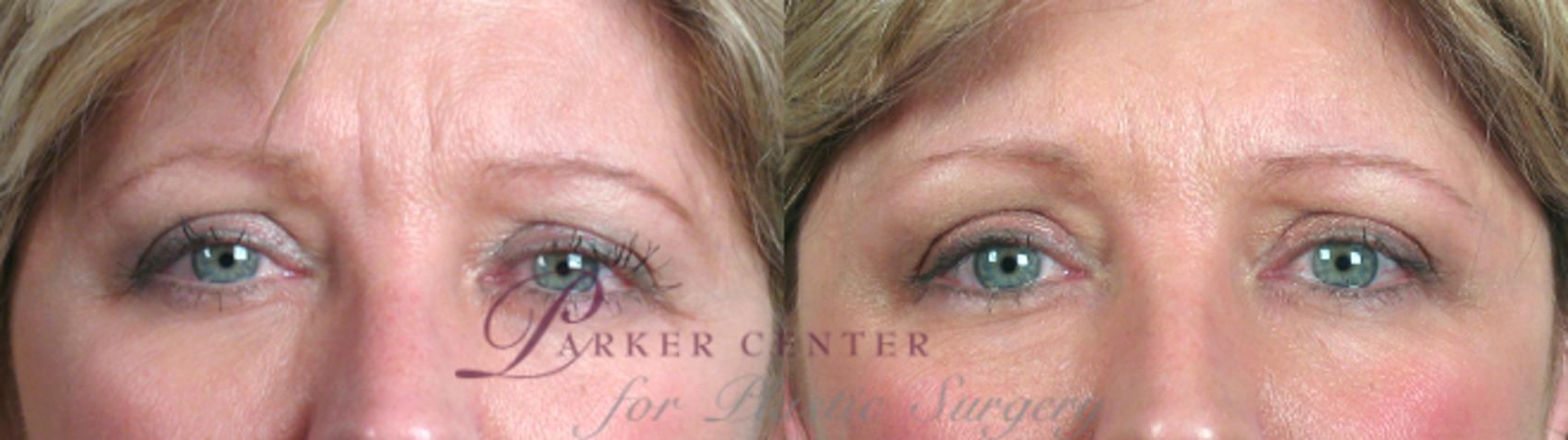 Eyelid Lift Case 63 Before & After View #2 | Paramus, NJ | Parker Center for Plastic Surgery