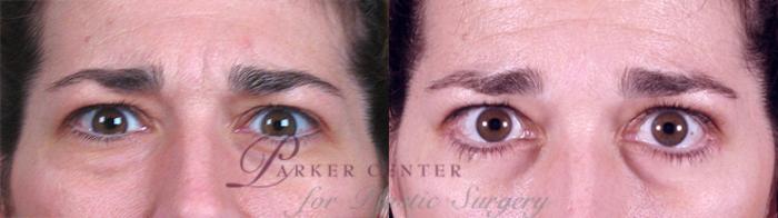 Eyelid Lift Case 64 Before & After View #1 | Paramus, NJ | Parker Center for Plastic Surgery
