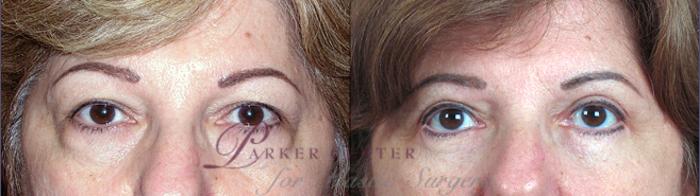 Eyelid Lift Case 65 Before & After View #1 | Paramus, NJ | Parker Center for Plastic Surgery