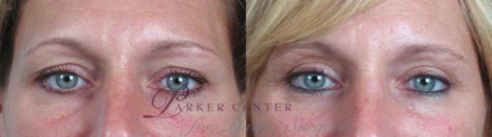 Eyelid Lift Case 67 Before & After View #1 | Paramus, NJ | Parker Center for Plastic Surgery