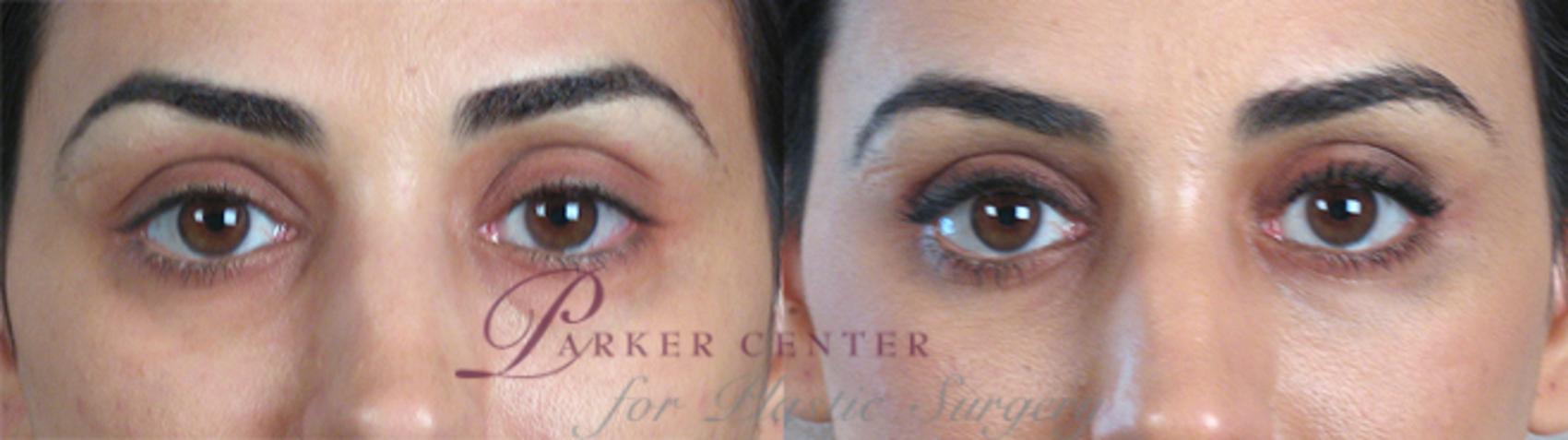 Eyelid Lift Case 69 Before & After View #1 | Paramus, NJ | Parker Center for Plastic Surgery