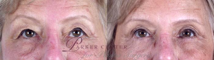 Eyelid Lift Case 70 Before & After View #1 | Paramus, NJ | Parker Center for Plastic Surgery