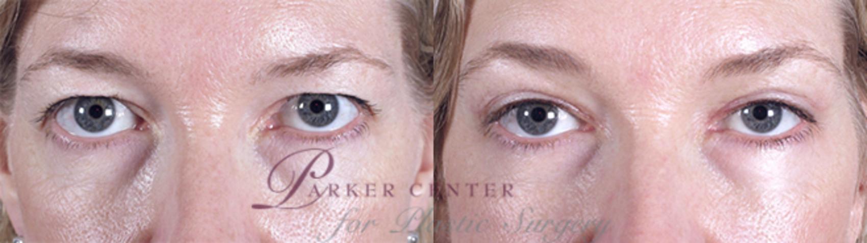 Nonsurgical Face Procedures Case 72 Before & After View #1 | Paramus, NJ | Parker Center for Plastic Surgery