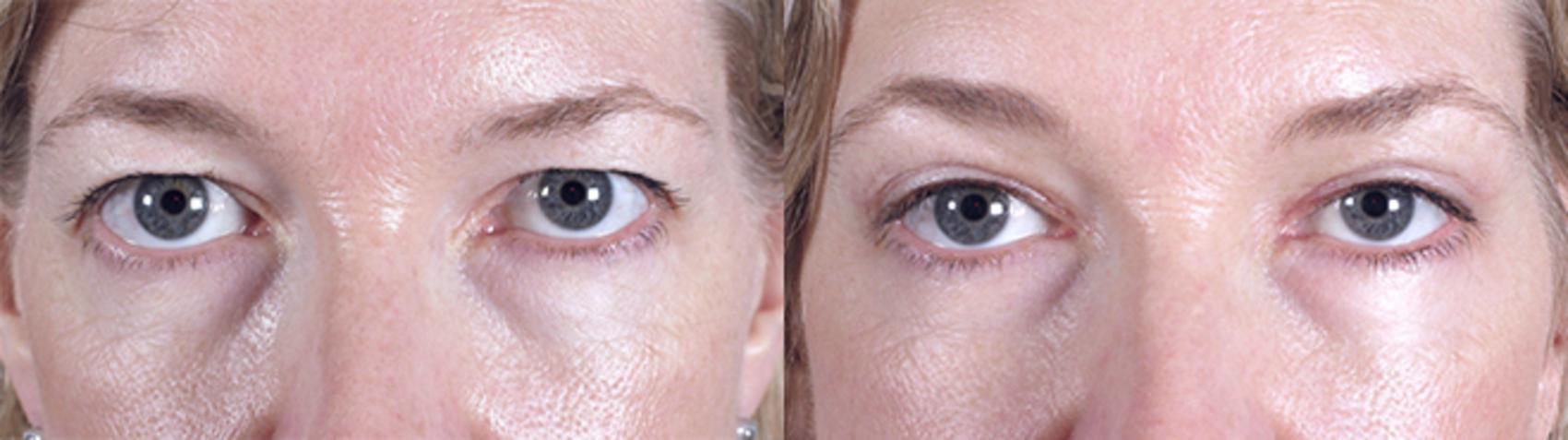 Eyelid Lift Case 72 Before & After View #1 | Paramus, NJ | Parker Center for Plastic Surgery