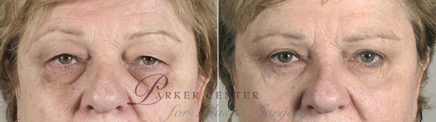 Eyelid Lift Case 75 Before & After View #1 | Paramus, NJ | Parker Center for Plastic Surgery