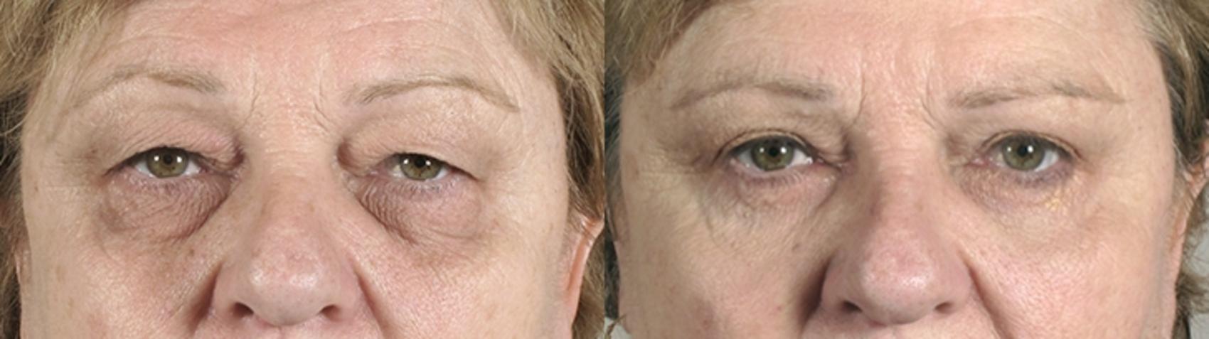 Eyelid Lift Case 75 Before & After View #1 | Paramus, New Jersey | Parker Center for Plastic Surgery