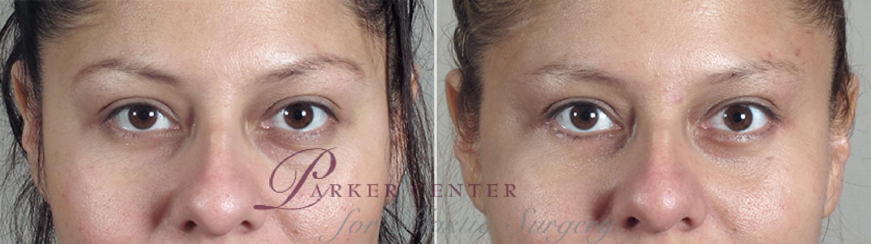 Eyelid Lift Case 76 Before & After View #1 | Paramus, NJ | Parker Center for Plastic Surgery
