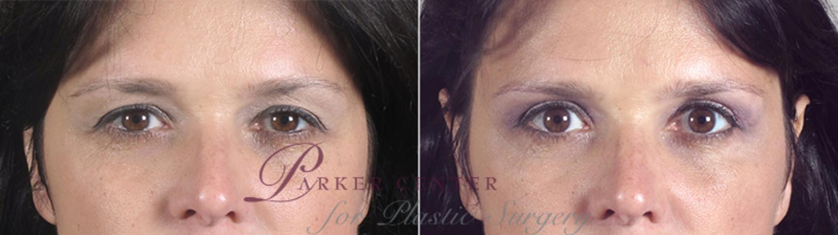 Eyelid Lift Case 77 Before & After View #1 | Paramus, NJ | Parker Center for Plastic Surgery