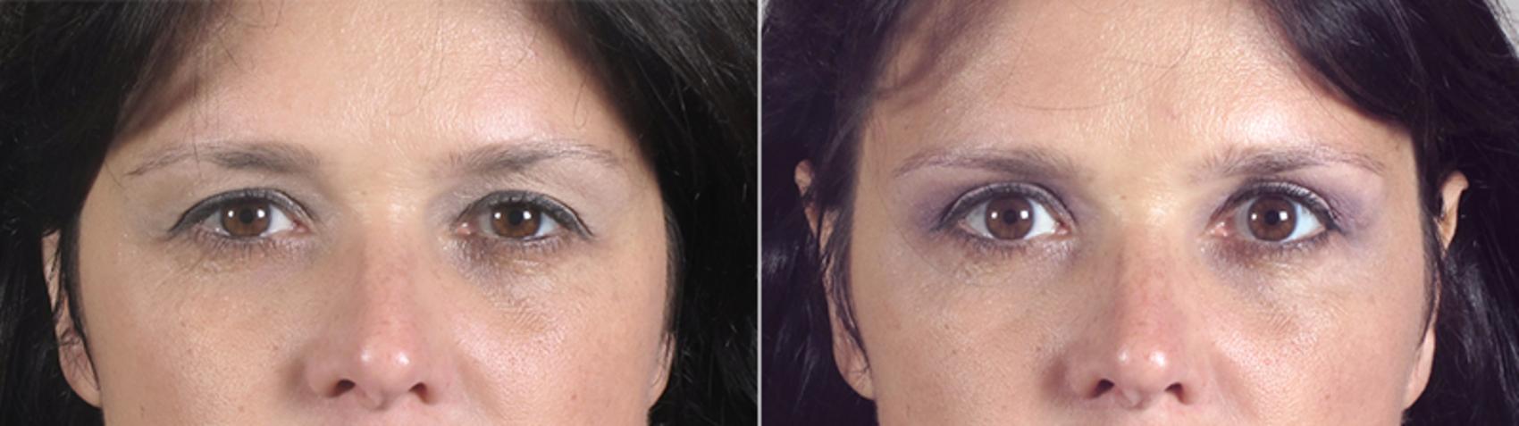 Eyelid Lift Case 77 Before & After View #1 | Paramus, New Jersey | Parker Center for Plastic Surgery