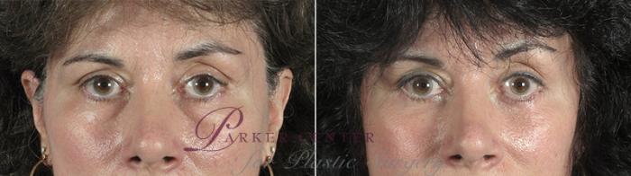 Eyelid Lift Case 78 Before & After View #1 | Paramus, NJ | Parker Center for Plastic Surgery