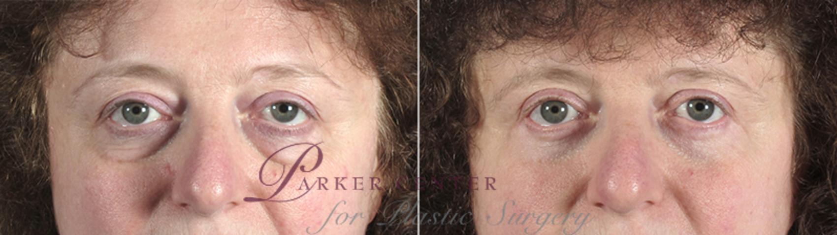 Eyelid Lift Case 79 Before & After View #1 | Paramus, NJ | Parker Center for Plastic Surgery