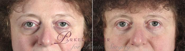 Eyelid Lift Case 79 Before & After View #1 | Paramus, NJ | Parker Center for Plastic Surgery