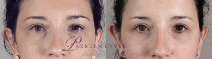 Eyelid Lift Case 80 Before & After View #1 | Paramus, NJ | Parker Center for Plastic Surgery