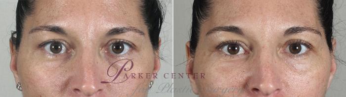 Eyelid Lift Case 81 Before & After View #1 | Paramus, NJ | Parker Center for Plastic Surgery