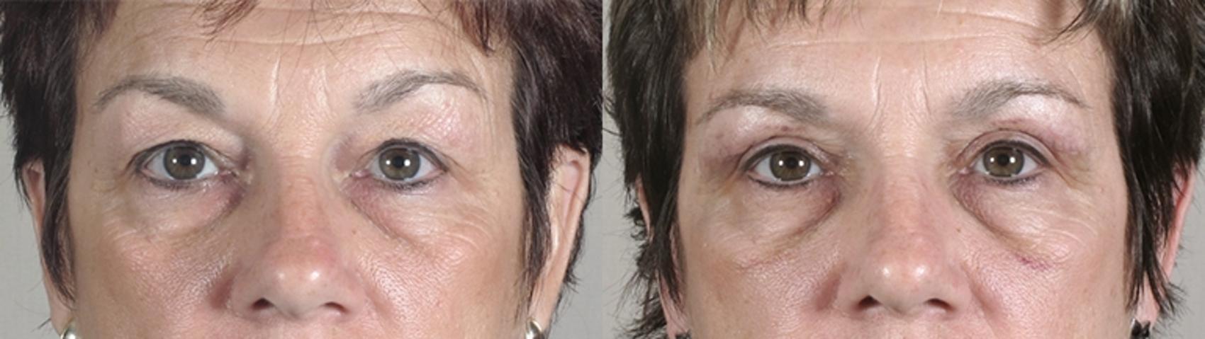 Eyelid Lift Case 82 Before & After View #1 | Paramus, NJ | Parker Center for Plastic Surgery