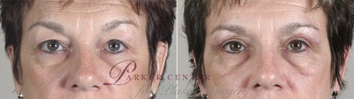 Eyelid Lift Case 82 Before & After View #1 | Paramus, NJ | Parker Center for Plastic Surgery
