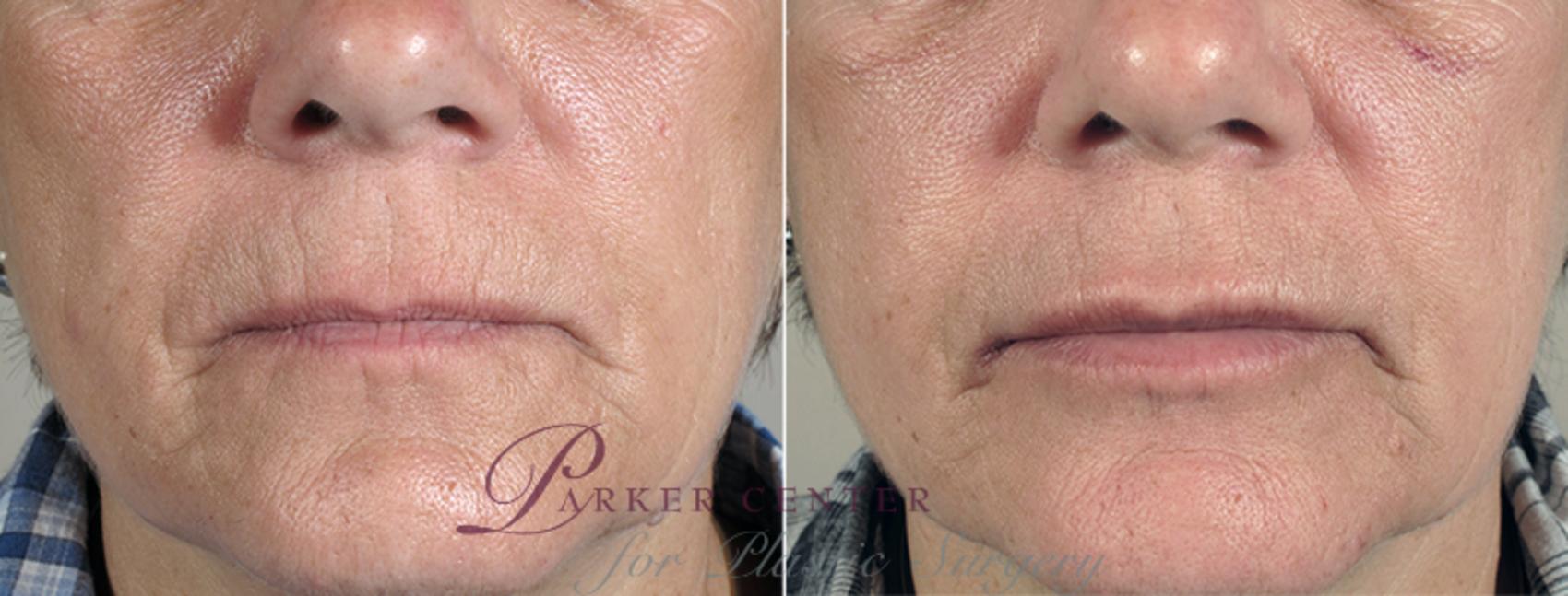 Lip Enhancement Case 82 Before & After View #2 | Paramus, NJ | Parker Center for Plastic Surgery