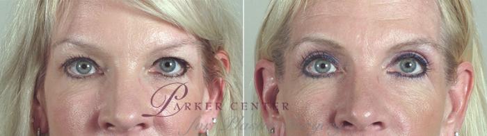 Eyelid Lift Case 86 Before & After View #1 | Paramus, NJ | Parker Center for Plastic Surgery