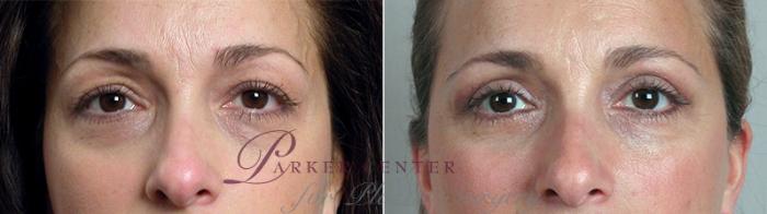 Eyelid Lift Case 87 Before & After View #1 | Paramus, NJ | Parker Center for Plastic Surgery