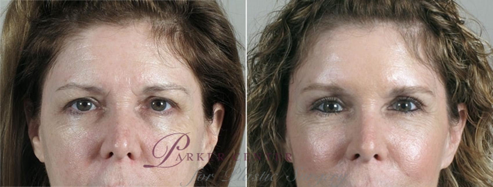 Eyelid Lift Case 870 Before & After View #4 | Paramus, NJ | Parker Center for Plastic Surgery