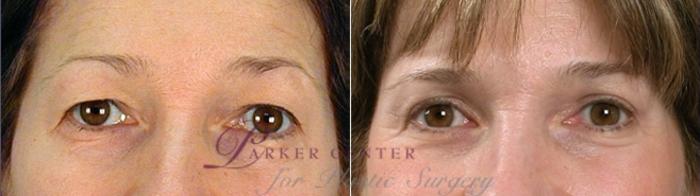 Eyelid Lift Case 875 Before & After View #4 | Paramus, NJ | Parker Center for Plastic Surgery