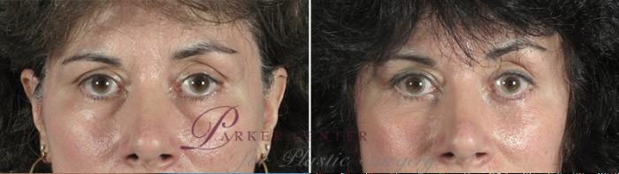 Eyelid Lift Case 876 Before & After View #4 | Paramus, NJ | Parker Center for Plastic Surgery