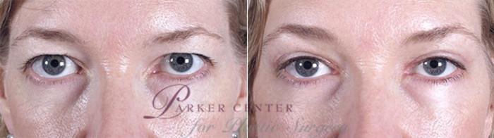 Eyelid Lift Case 879 Before & After View #4 | Paramus, NJ | Parker Center for Plastic Surgery