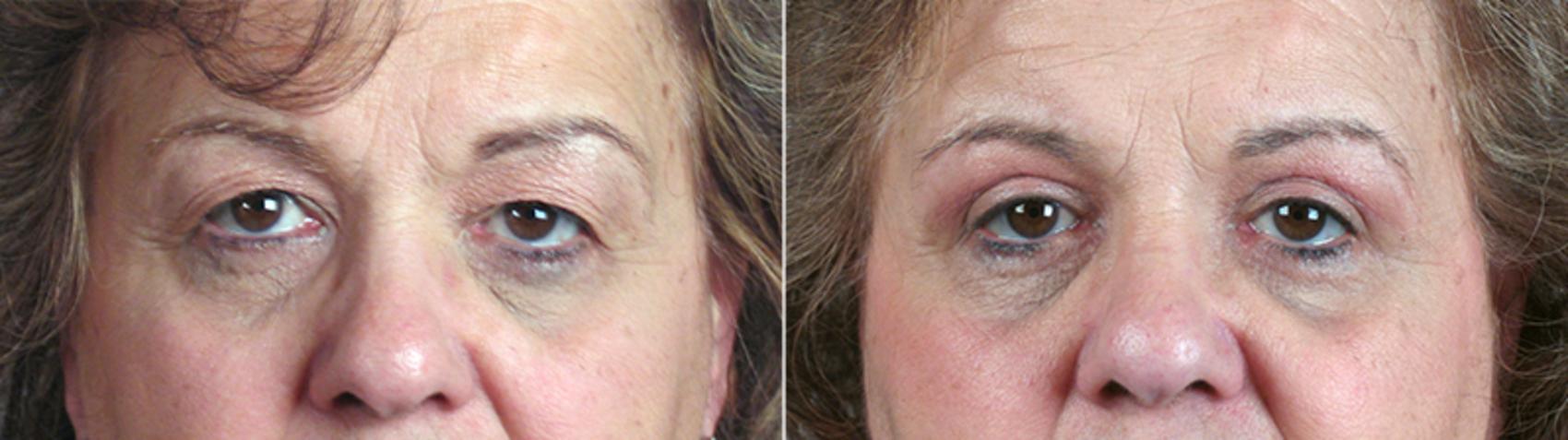 Eyelid Lift Case 88 Before & After View #1 | Paramus, New Jersey | Parker Center for Plastic Surgery