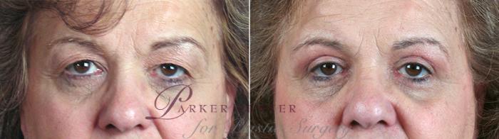 Eyelid Lift Case 88 Before & After View #1 | Paramus, NJ | Parker Center for Plastic Surgery