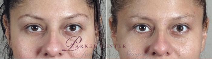 Eyelid Lift Case 881 Before & After View #4 | Paramus, NJ | Parker Center for Plastic Surgery
