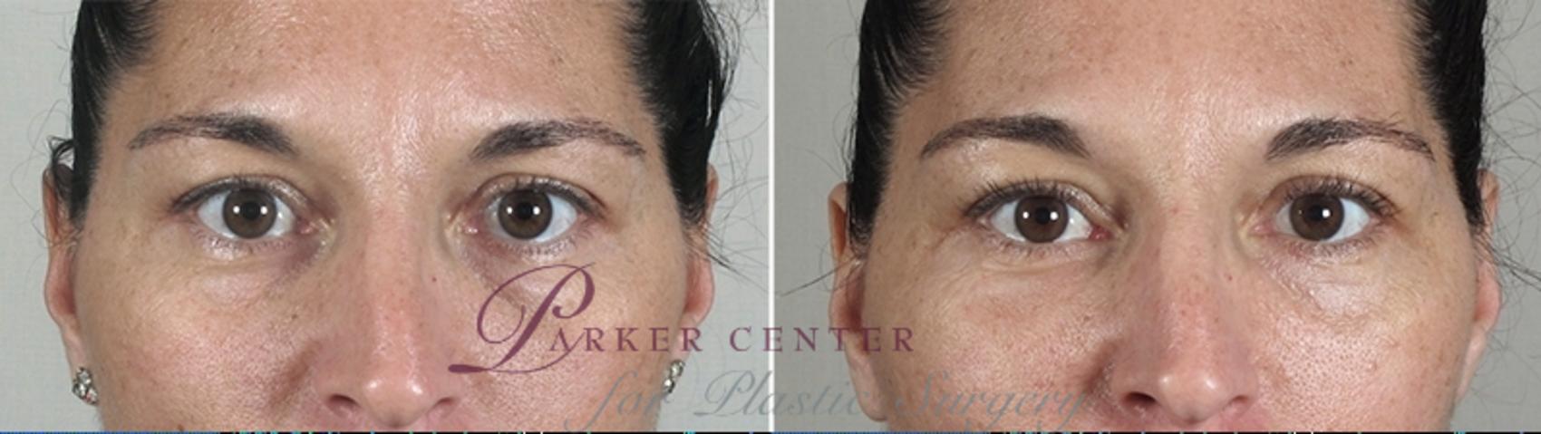 Eyelid Lift Case 882 Before & After View #4 | Paramus, NJ | Parker Center for Plastic Surgery